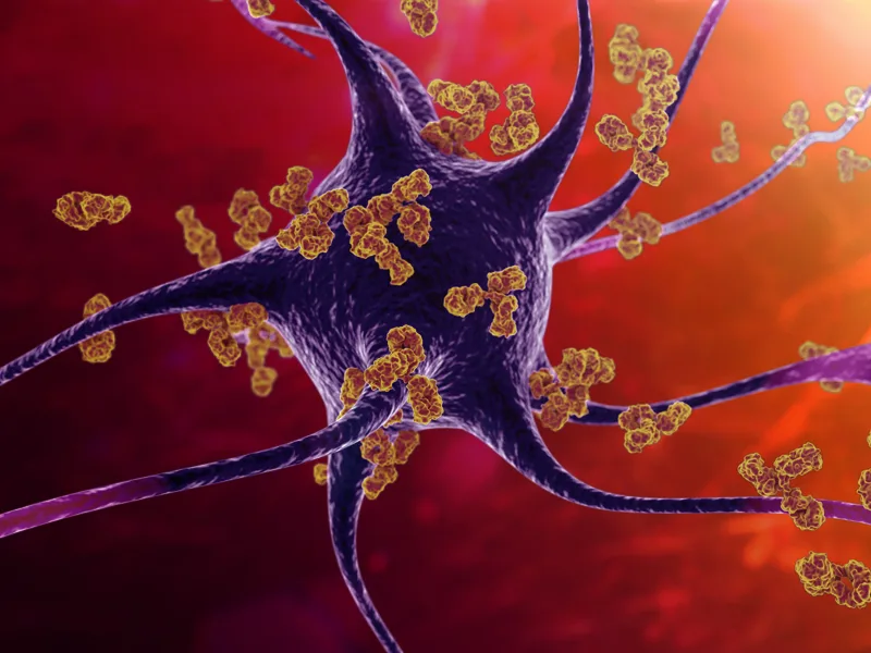 3D illustration of a neuron surrounded by abnormal protein deposits, representing a rare neurological disorder.